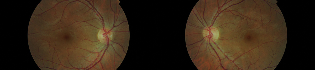 Desde óptica tonos en Cuenca tomamos una imagen de tu ojo con nuestro retinógrafo para el estudio de posibles patologías, somos terapeutas, somos tu solución 